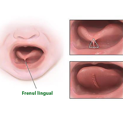 Operatia de frenotomie linguala